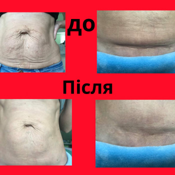 RF- ліфтинг
                    Косметолог-эстетист  Ивано-Франковск