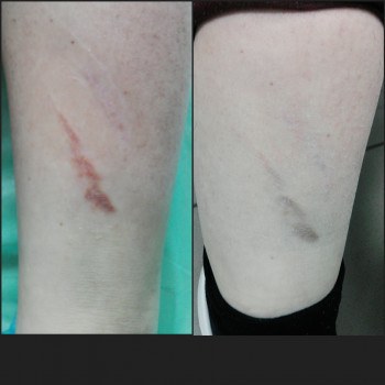 RF- ліфтинг
                    Косметолог-эстетист  Ивано-Франковск