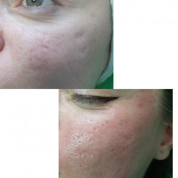 RF- ліфтинг
                    Косметолог-эстетист  Ивано-Франковск