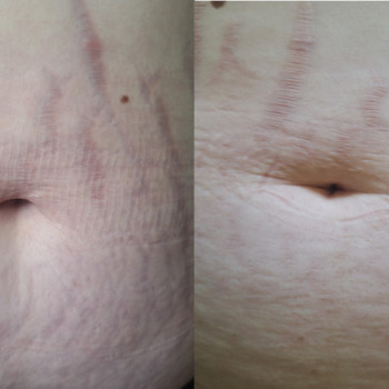 RF- ліфтинг
                    Косметолог-эстетист  Ивано-Франковск