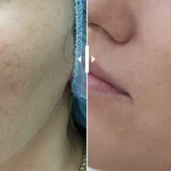 Мезотерапія
                    Косметолог-эстетист  Ивано-Франковск