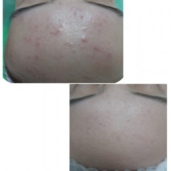 Плазмотерапія
                    Косметолог-естетист  Івано-Франківськ