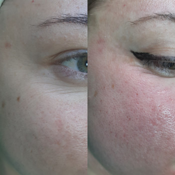 Плазмотерапія
                    Косметолог-естетист  Івано-Франківськ