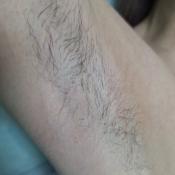 Воскова депіляція
                    Косметолог-эстетист  Ивано-Франковск