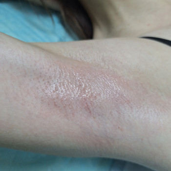 Воскова депіляція
                    Косметолог-эстетист  Ивано-Франковск