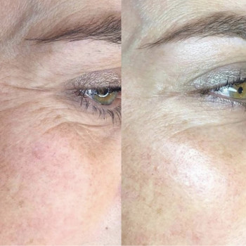 Експрес догляд
                    Косметолог-эстетист  Ивано-Франковск