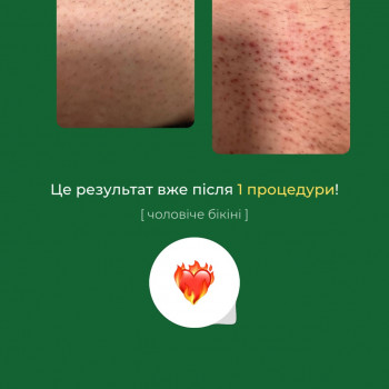 Чоловіче бікіні. Результат після першої процедури Лазерної епіляції