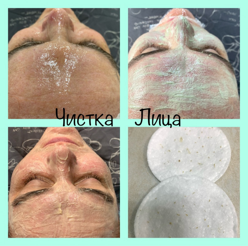 Чистка обличчя механічна, фото - Мастер по пирсингу Татьяна Ананьева