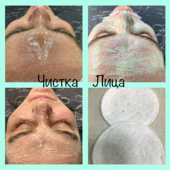 Чистка обличчя комбінована