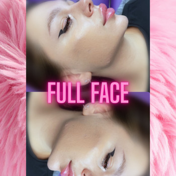 Фул фейс філлерами 
Вилиці, кути Джолі та підборіддя. Тривалість процедури 30 хв
Не боляче

   