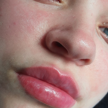 Збільшення губ 
 #контурнапластикагуб
 #аугментаціягуб
 #Збільшеннягуб