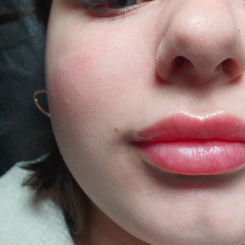 Збільшення губ заживші 
 #контурнапластикагуб
 #збільшеннягуб 
 #аугментаціягуб