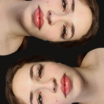 Збільшення губ 
 
  
 