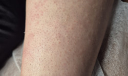 Электроэпиляция Майстер епіляції  Одеса