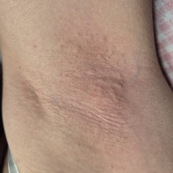 Після процедури