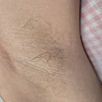 До процедури