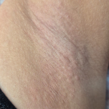 Після процедури