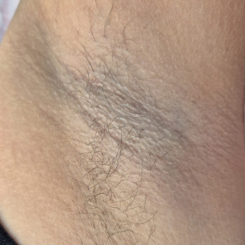 До процедури