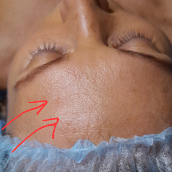 Процедура мікронідлінга ДО