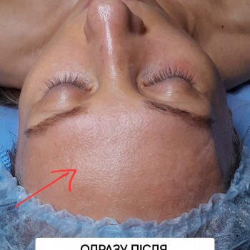 Одразу після процедури