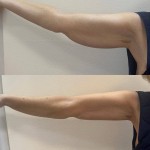 Безголковий RF-ліфтинг для рук Дерматолог косметолог Нелли Киев