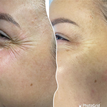 Ботулінотерапія