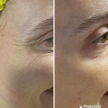 Ботулінотерапія