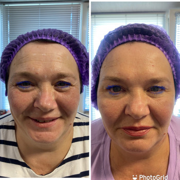 Ботулінотерапія