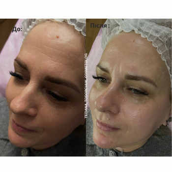 Чистка обличчя + пілінг + маска по-типу шкіри #чисткаобличчя 
 #косметологтодорчук
 #косметолог