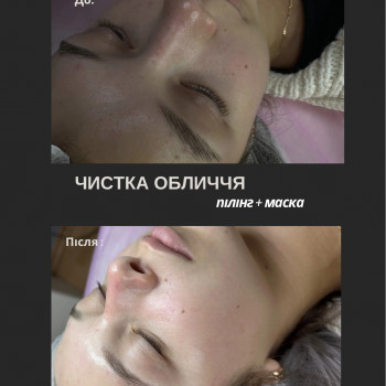 Чистка обличчя + пілінг + маска по-типу шкіри #чисткаобличчя 
 #косметологтодорчук
 #косметолог
