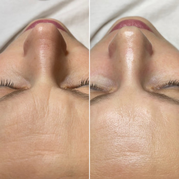 Карбоксітерапія — це процедура, яка запускає природне оновлення шкіри 🌬️

Під час реакції “CO₂ + ш...