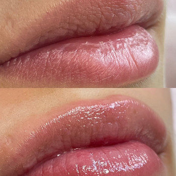 Hidro Lips – це інноваційна процедура, яка не збільшує губи філерами, а глибоко їх зволожує та відно...