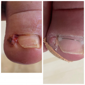 Оніхокриптоз (врослі нігті)
                    Подолог Аліна Лубны