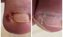 Оніхокриптоз (врослі нігті) Подолог Аліна Лубны