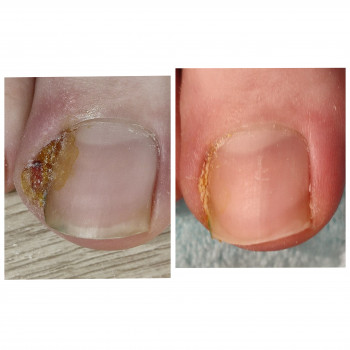 Оніхокриптоз (врослі нігті)
                    Подолог Аліна Лубны