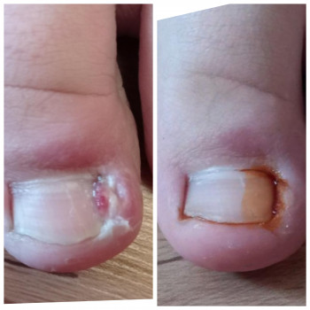 Оніхокриптоз (врослі нігті)
                    Подолог Аліна Лубны