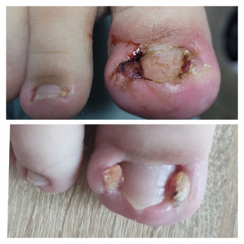 Оніхокриптоз (врослі нігті)
                    Подолог Аліна Лубны