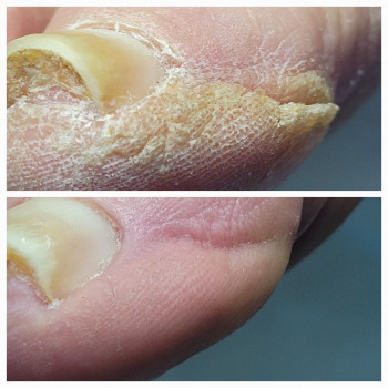 Подологічна чистка стопи та нігтів різної складності
                    Подолог Аліна Лубны