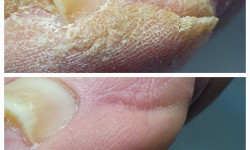 Подологічна чистка стопи та нігтів різної складності Подолог Аліна Лубны