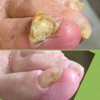 Подологічна чистка стопи та нігтів різної складності
                    Подолог Аліна Лубны