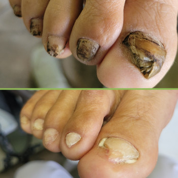 Подологічна чистка стопи та нігтів різної складності
                    Подолог Аліна Лубны