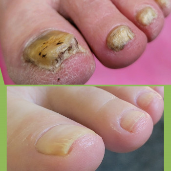 Подологічна чистка стопи та нігтів різної складності
                    Подолог Аліна Лубны