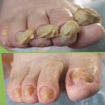 Подологічна чистка стопи та нігтів різної складності
                    Подолог Аліна Лубны