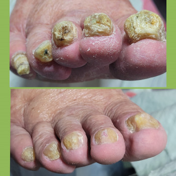 Подологічна чистка стопи та нігтів різної складності
                    Подолог Аліна Лубны