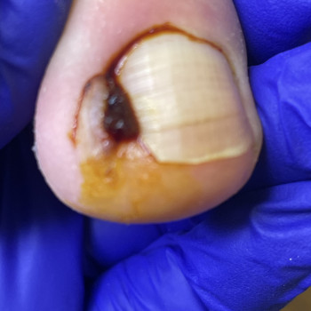 Обробка врослого нігтя I-II ст. видалення осколка, тампонування, пов'язка  (процедура не медична не потребує анастезії)
                    Центры подологии Calutte Харьков