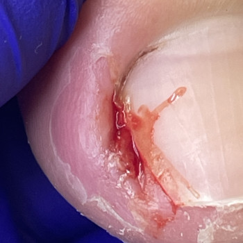 Обробка врослого нігтя I-II ст. видалення осколка, тампонування, пов'язка  (процедура не медична не потребує анастезії)
                    Центры подологии Calutte Харьков