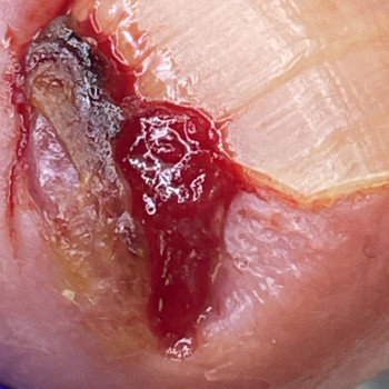 Обробка врослого нігтя I-II ст. видалення осколка, тампонування, пов'язка  (процедура не медична не потребує анастезії)
                    Центры подологии Calutte Харьков