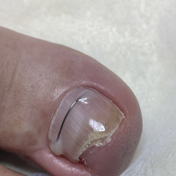 Встановлення титанової нитки (корекція врослого нігтя)
                    Центры подологии Calutte Харьков