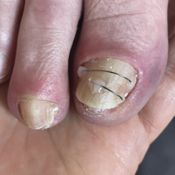 Встановлення титанової нитки (корекція врослого нігтя)
                    Центры подологии Calutte Харьков