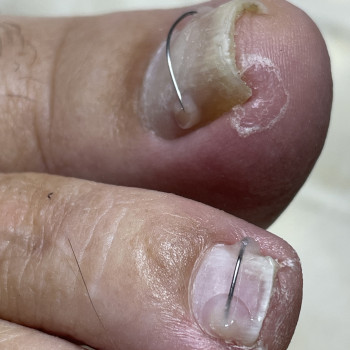 Встановлення титанової нитки (корекція врослого нігтя)
                    Центры подологии Calutte Харьков